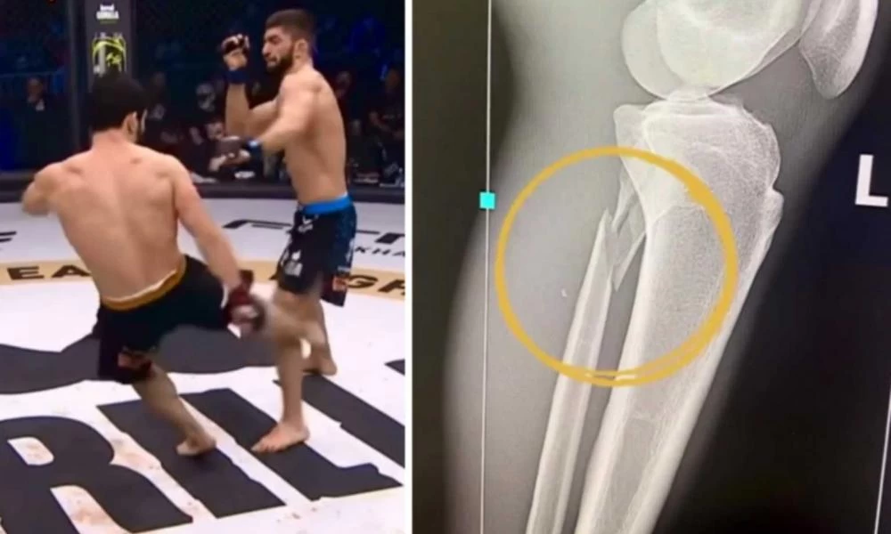 Αθλητής του ΜΜΑ έσπασε το πόδι του στο ρινγκ και γέλαγε (Βίντεο)